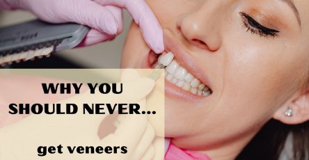 Why you should never get veneers