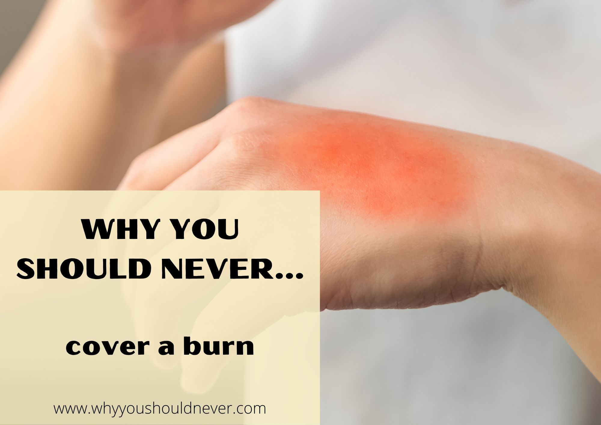 Why You Should Never Cover A Burn